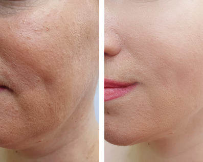 Anna: 6 weeks with Restora