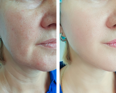 Linda: 3 weeks with Restora